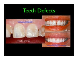 Teeth Defects
http://3.bp.blogspot.com/_r2K1IjhvZV0/TB_NX0Y6K-I/
AAAAAAAAADI/8YUuvcQ312g/s1600/erosion.jpg

http://t1.gstatic.com/images?
q=tbn:ANd9GcSoIFfH6j4RLrYKO_QtZDC_7qMc7yeGrD6hPrGm-8d
_b4EjS3H75g

 