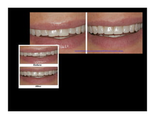 http://dentalclinicintoronto.ca/wp-content/uploads/2010/07/contouring_before_after.jpg

 