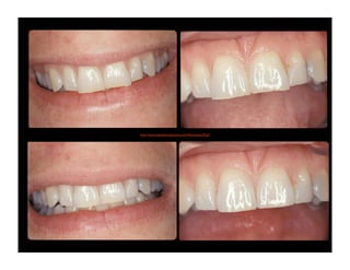 http://www.dentalcomposites.com/Recontabc29.gif

 