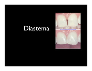 Diastema

http://www.dentalcomposites.com/Didddaste44.gif

 