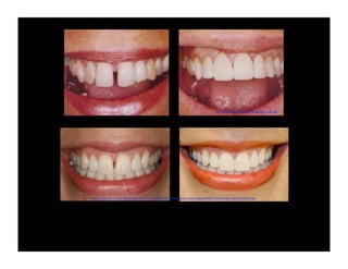 http://www.renicholsdds.com/images/gap_smile.jpg

http://www.zimbio.com/go/vGZHexiokZ6/http://www.brooksidedental.com/blog/wp-content/uploads/2008/12/diastema-after-cosmetic-dentistry.jpg

 