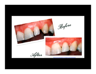 http://www.yourdentistingoa.com/images/Cosmetic-Bonding-3.jpg

 