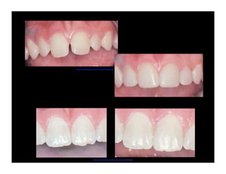 http://www.dentalcomposites.com/rotate2.jpg

http://www.dentalcomposites.com/rotate5055.gif

 