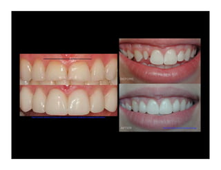 http://cosmetic-dentistry-and-porcelain-veneers.com/smile-design/gum-shape/gums9drhuefner/

http://eshomdds.com/services/gumcont.jpg

 