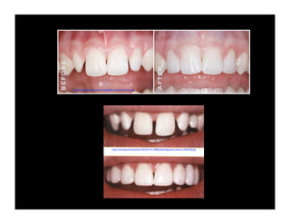 http://www.blakesmiles.com/img/before-after/veneer-b-a.jpg

http://2.imimg.com/data2/LL/NO/MY-2113805/bleahingtooth-veeners-250x250.jpg

 