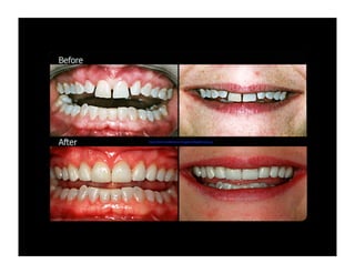 http://sherwooddental.ca/images/smilegallery/6.png

 