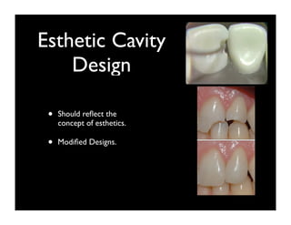 Esthetic Cavity
Design
•

Should reﬂect the
concept of esthetics.

•

Modiﬁed Designs.

 