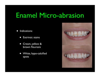 Enamel Micro-abrasion
•

Indications:

•
•

Extrinsic stains

•

White, hypo-calciﬁed
spots

Cream, yellow &
brown ﬂourosis

 