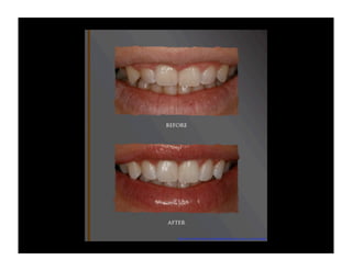 http://www.drdanmckay.com/images/results_laser_gum_contouring.jpg

 