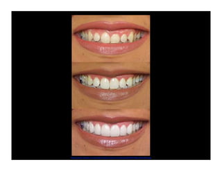 http://cosmetic-dentistry-and-porcelain-veneers.com/wp-content/uploads/2010/10/gums6drhuefner.jpg

 