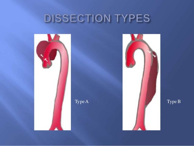 Contemporary management of acute type b aortic dissections