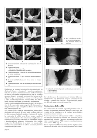 1

2

A

B

7 A, B, C. Contención del tobi3

4

5

llo. Limitación del cajón anterior mediante vendas no
elásticas.

6

C

1 Contención del tobillo. Colocación de la primera venda de 6 cm
de ancho.

A

2 Contención del tobillo:
— tras colocar la primera venda;
— colocación de la primera venda no elástica.

3 Contención del tobillo. Limitación del varo del retropié mediante
las vendas no elásticas.

4 Contención del tobillo. Fin de la colocación de las vendas externas.

5 Contención del tobillo. Colocación de las vendas no elásticas
internas.

6 Contención del tobillo. Paso de las vendas por detrás del calcáneo.

Finalmente, se recubre la contención con una venda no
elástica, de 6 cm, «en forma de 8», tapando completamente la piel. Se cerrará por delante con una venda circular que
recubra la articulación mediotarsiana y la base de los metatarsianos. Una vez terminada la contención, hay que pedir
al paciente que realice ejercicios como ponerse de puntillas
y sobre los talones y flexionar ambas rodillas. No debería
sentir ninguna molestia al efectuar tales movimientos.
Pueden realizarse radiografías antes y después de la colocación de la contención para comprobar la disminución o
desaparición del cajón astragalino y el varo de la articulación tibiotarsiana (fig. 8).
Esta contención del tobillo se realiza según el mismo principio, independientemente de que el sujeto sea deportista o no.
La diferencia estribará en la tensión y el número de vendas.
La contención de tobillo no se llevará a cabo cuando el
edema sea importante. Para evitar esta complicación, se
comenzará en las primeras 48 horas un tratamiento médico
y kinesiterapéutico adaptado (fisioterapia, frío, vendaje
compresivo, deambulación sin apoyo o con muletas). Las
contenciones que recubren un relleno acolchado permiten
tratamientos expectantes.
página 4

B
8 Radiografía del tobillo. Signos de varo forzado y de cajón anterior
A. Sin contención.
B. Con contención.

En todos los casos, «la contención debe aliviar el dolor muy
rápidamente» [20], el terapeuta adaptará la técnica de contención a cada afección concreta y los movimientos dolorosos deben desaparecer con la contención.

Contenciones de la rodilla
Las contenciones de la rodilla se pueden proponer tanto en
lesiones ligamentosas periféricas benignas como en la prevención de las recidivas y en la vuelta a las actividades
deportivas sobre el terreno.
Son complementarias del tratamiento médico y ortopédico.
Las lesiones articulares de la rodilla más frecuentes son los
esguinces por rotación. Pueden ocurrir tanto en valgo, flexión y rotación externa (VFE) como en varo, flexión y rotación interna (VRI) (fig. 9).
En los esguinces en VFE, las lesiones afectan al plano capsular interno de detrás hacia adelante (ligamento lateral inter-

 