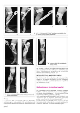 C

10
A

B

A, B, C, D. Contención de la rodilla. Vendas antirrotatorias externas en
un esguince en varo y rotación externa (VRE).

12
A

B

D

Contención en un caso de inestabilidad
rotuliana externa.

na. Tan sólo se colocan las vendas antirrotatorias externas
del compartimento externo, a las que se añaden tiras que
limiten el desplazamiento lateral externo de la rótula para
favorecer el recentrado de ésta (fig. 12).

Otras contenciones del miembro inferior
Las afecciones de la articulación mediotarsiana y de los
dedos del pie pueden beneficiarse de un tratamiento
mediante contención. Las más habituales son las sindactilias de los dedos del pie.

Aplicaciones en el miembro superior
C
11

D

A, B, C, D. Contenciones de la rodilla. Vendas antirrotatorias de
bloqueo suplementarias.

Técnica
La colocación de la contención se realiza con el miembro
inferior en apoyo, en posición de VRI. La realización de la
contención es idéntica a la contención antirrotatoria exterpágina 6

Las contenciones pueden adaptarse con mayor o menor
facilidad a todas las articulaciones del miembro superior.
Los datos anatomofisiológicos y el conocimiento de los
mecanismos de lesión permitirán realizarlas.
En lo relativo al hombro, las lesiones de la articulación acromioclavicular que no requieran tratamiento quirúrgico
podrán tratarse con una contención semirrígida.
La colocación de las vendas debe limitar el ascenso y el cajón
anteroposterior de la clavícula. La contención se realiza con
el brazo en abducción, con vendas elásticas y rígidas.

 
