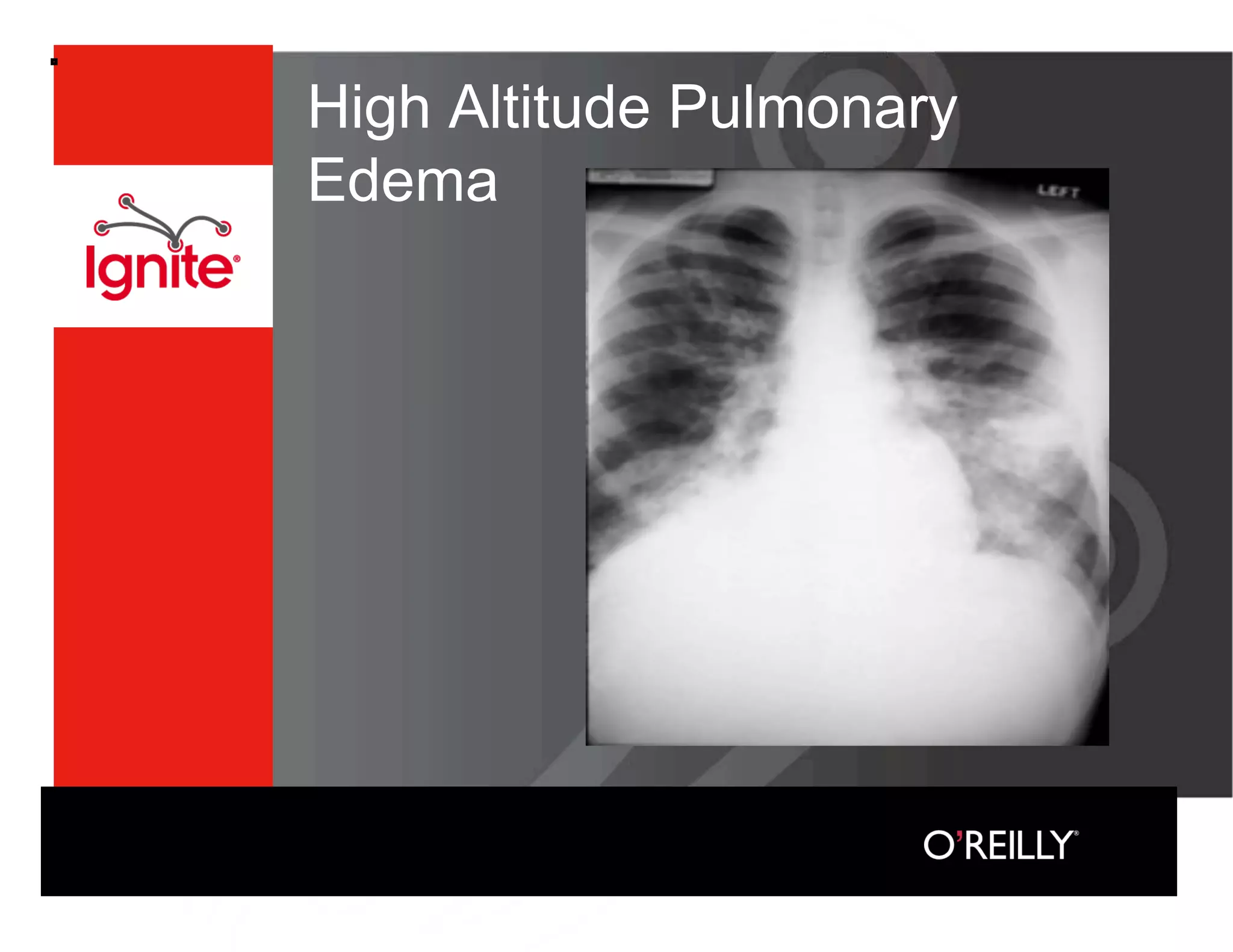 High Altitude Pulmonary
Edema
 