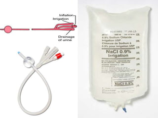 Continuous bladder irrigation