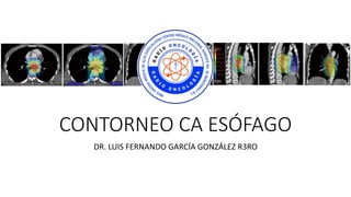 CONTORNEO CA ESÓFAGO
DR. LUIS FERNANDO GARCÍA GONZÁLEZ R3RO
 