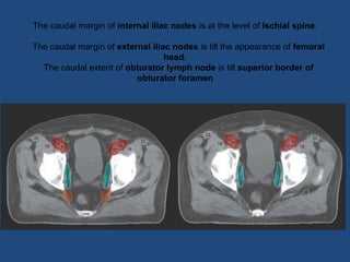 The caudal margin of internal iliac nodes is at the level of Ischial spine.
The caudal margin of external iliac nodes is till the appearance of femoral
head.
The caudal extent of obturator lymph node is till superior border of
obturator foramen
 