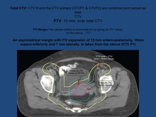 Total CTV: CTV N and the CTV primary (CTVP1 & CTVP2) are combined and named as
total
CTV
PTV: 10 mm over total CTV
ITV Margin:The uterine motion is accounted for by giving an ITV margin
on the uterus….???
An asymmetrical margin with ITV expansion of 15 mm antero-posteriorly, 15mm
supero-inferiorly and 7 mm laterally, is taken from the uterus (CTV P1)
 