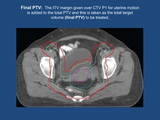 Final PTV: The ITV margin given over CTV P1 for uterine motion
is added to the total PTV and this is taken as the total target
volume (final PTV) to be treated.
 