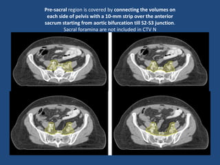 Pre-sacral region is covered by connecting the volumes on
each side of pelvis with a 10-mm strip over the anterior
sacrum starting from aortic bifurcation till S2-S3 junction.
Sacral foramina are not included in CTV N
 