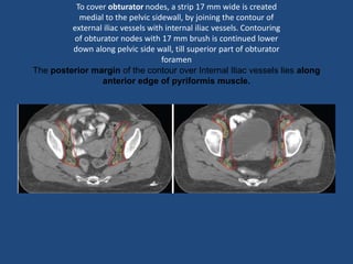 To cover obturator nodes, a strip 17 mm wide is created
medial to the pelvic sidewall, by joining the contour of
external iliac vessels with internal iliac vessels. Contouring
of obturator nodes with 17 mm brush is continued lower
down along pelvic side wall, till superior part of obturator
foramen
The posterior margin of the contour over Internal Iliac vessels lies along
anterior edge of pyriformis muscle.
 