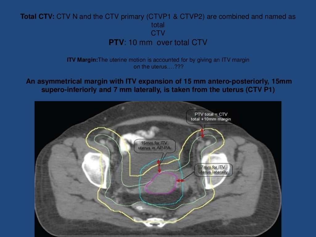 Contouring guidelines Cervix IMRT