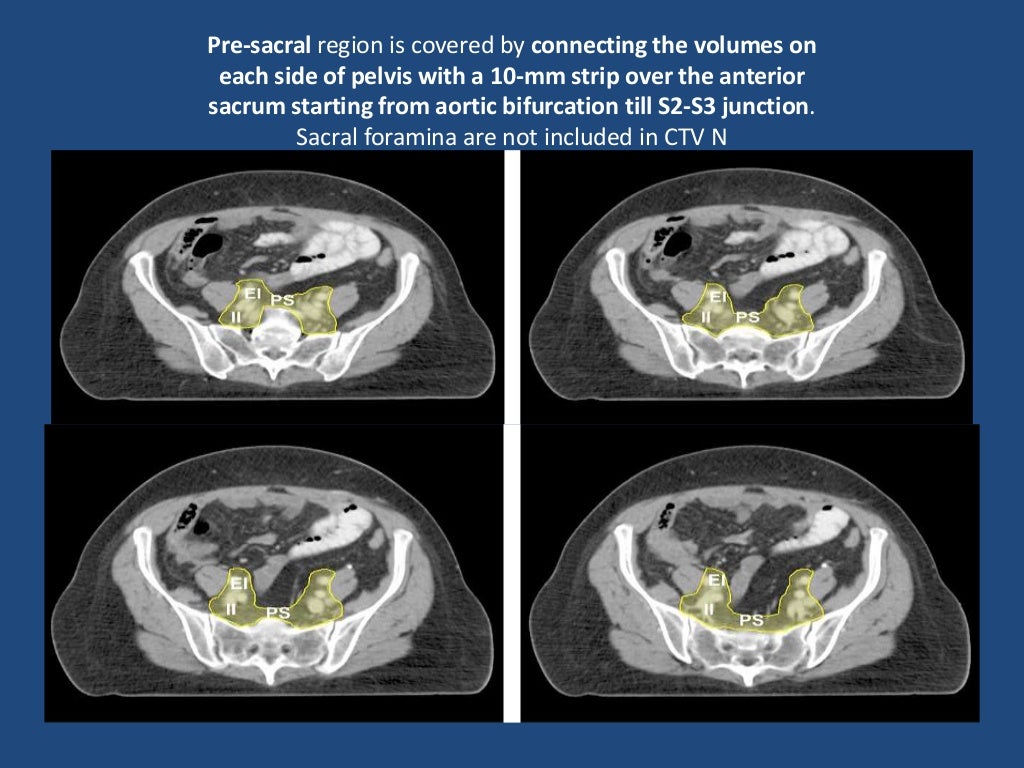 Contouring guidelines Cervix IMRT
