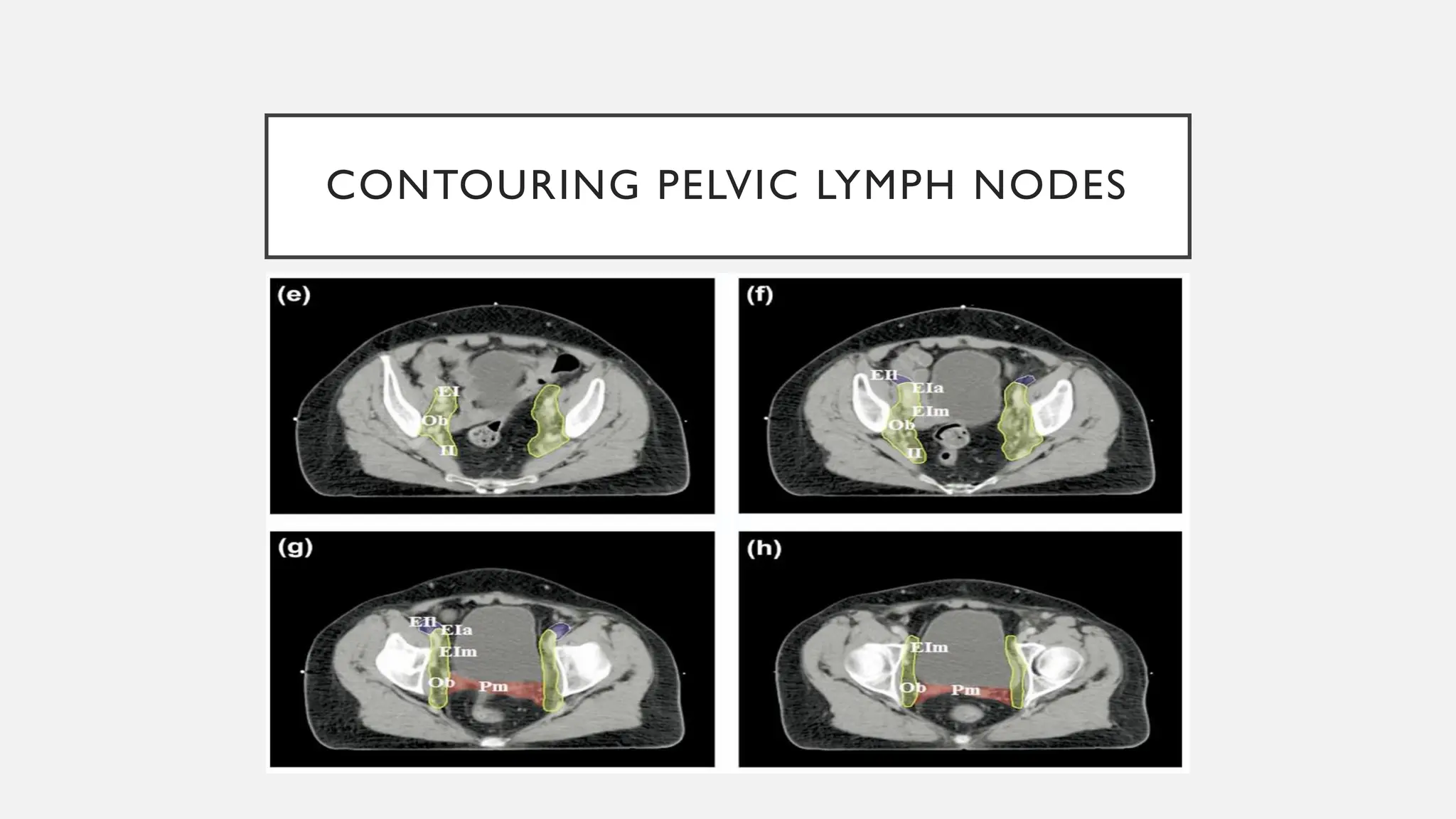 contouring guidelines ca cervix.pdf