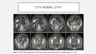 Roundel Ctv Examples contouring guidelines ca cervix.pdf