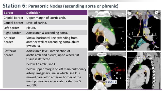 Contouring of CTV Lymph nodes in NSCLC (Part III) | PPT