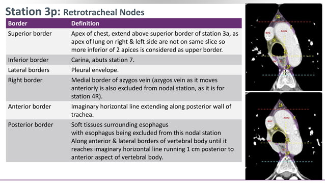 Contouring of CTV Lymph nodes in NSCLC (Part III) | PPT