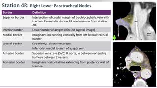 Contouring of CTV Lymph nodes in NSCLC (Part III) | PPTX