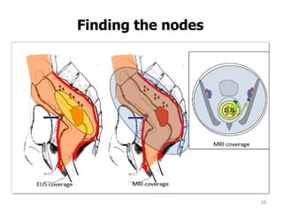 10
Finding the nodes
 