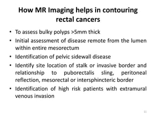 How MR Imaging helps in contouring
rectal cancers
• To assess bulky polyps >5mm thick
• Initial assessment of disease remote from the lumen
within entire mesorectum
• Identification of pelvic sidewall disease
• Identify site location of stalk or invasive border and
relationship to puborectalis sling, peritoneal
reflection, mesorectal or intersphincteric border
• Identification of high risk patients with extramural
venous invasion
11
 