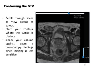 20
Contouring the GTV
• Scroll through slices
to view extent of
tumor.
• Start your contour
where the tumor is
obvious
• Check your volume
against exam /
colonoscopy findings
since imaging is less
sensitive
 
