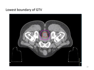 Lowest boundary of GTV
22
 