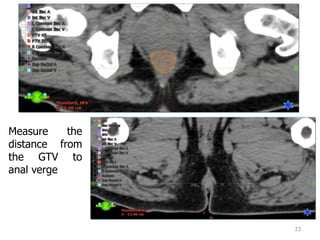 23
Measure the
distance from
the GTV to
anal verge
 