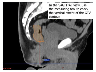24
In the SAGITTAL view, use
the measuring tool to check
the vertical extent of the GTV
contour.
 
