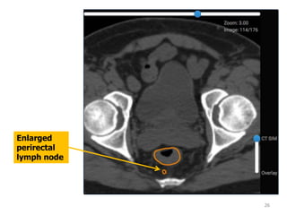 26
Enlarged
perirectal
lymph node
 