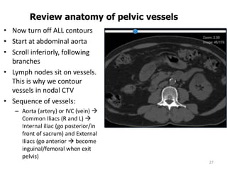 • Now turn off ALL contours
• Start at abdominal aorta
• Scroll inferiorly, following
branches
• Lymph nodes sit on vessels.
This is why we contour
vessels in nodal CTV
• Sequence of vessels:
– Aorta (artery) or IVC (vein) 
Common Iliacs (R and L) 
Internal iliac (go posterior/in
front of sacrum) and External
Iliacs (go anterior  become
inguinal/femoral when exit
pelvis)
27
Review anatomy of pelvic vessels
 