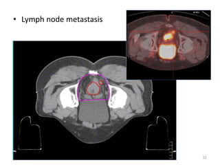 • Lymph node metastasis
31
 