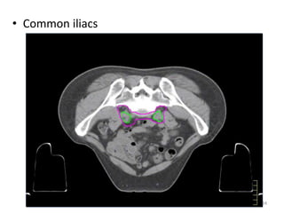 • Common iliacs
34
 