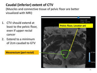 Caudal (inferior) extent of CTV
(Muscles and connective tissue of pelvic floor are better
visualized with MRI)
1. CTV should extend at
least to the pelvic floor,
even if upper rectal
cancer
2. Extend to a minimum
of 2cm caudad to GTV
36
Mesorectum (peri-rectal)
Pelvic floor, Levator ani
 