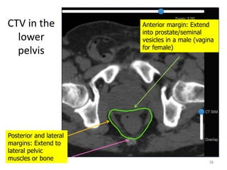 CTV in the
lower
pelvis
38
Posterior and lateral
margins: Extend to
lateral pelvic
muscles or bone
Anterior margin: Extend
into prostate/seminal
vesicles in a male (vagina
for female)
 