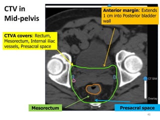 CTV in
Mid-pelvis
40
CTVA covers: Rectum,
Mesorectum, Internal iliac
vessels, Presacral space
Mesorectum Presacral space
Anterior margin: Extends
1 cm into Posterior bladder
wall
 