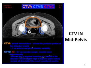 CTV IN
Mid-Pelvis
41
 