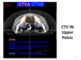 CTV IN
Upper
Pelvis
44
 