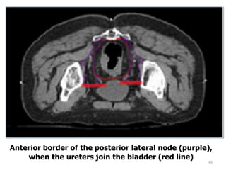 49
Anterior border of the posterior lateral node (purple),
when the ureters join the bladder (red line)
 