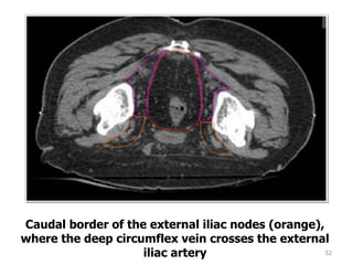 52
Caudal border of the external iliac nodes (orange),
where the deep circumflex vein crosses the external
iliac artery
 