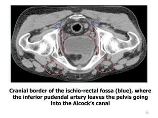 55
Cranial border of the ischio-rectal fossa (blue), where
the inferior pudendal artery leaves the pelvis going
into the Alcock’s canal
 